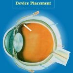 Neurotech makes plans for new plant IMPLANTED in the eye, the device releases the therapeutic agent continuously. /