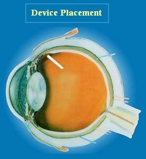 IMPLANTED in the eye, the device releases the therapeutic agent continuously. / IMPLANTED in the eye, the device releases the therapeutic agent continuously. /