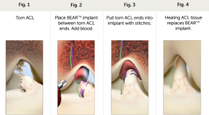 University Orthopedics adopts less invasive BEAR surgery for ACL repair